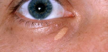 Лечение ксантилазмы в Клинике доктора Шаталова