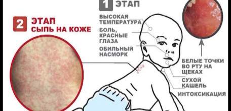 Осторожно – корь! Как уберечь себя и близких от острого инфекционного вирусного заболевания