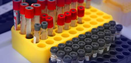 В Липецкой области зарегистрированы 65 новых случаев инфицирования COVID-19