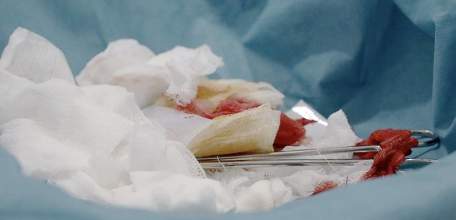 Прекращено уголовное дело в отношении врача, пациент которого умер от кровопотери