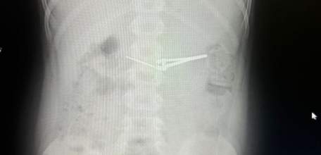 Мальчик умудрился проглотить целые щипцы для стрижки ногтей