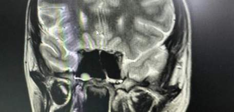 15-летнему мальчику из Ельца вскрыли абсцесс головного мозга: к осложнению привёл запущенный синусит