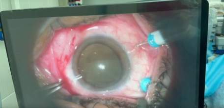 Накладные ресницы могли стоить зрения 32-летней ельчанке!