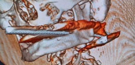 Хирурги Липецкой областной клинической больницы вытащили метровый металлический прут из горла 82-летнего пенсионера!