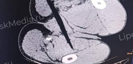 Напоровшегося на кол жителя Нигерии спасли в Липецкой области травматологи БСМП №1!