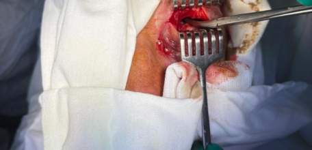 Отоларингологи и челюстно – лицевые хирурги областной клинической больницы спасли жизнь 65-летнему мужчине с воспаленным глазом