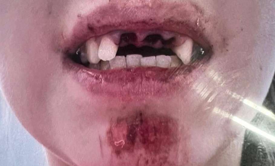 Без зубов чуть не осталась 16-летняя девушка