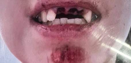 Без зубов чуть не осталась 16-летняя девушка