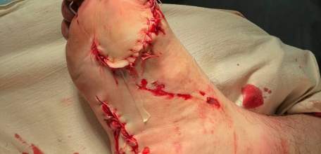 Врачи елецкой детской больницы буквально по кусочкам собрали стопу 17-летнего парня