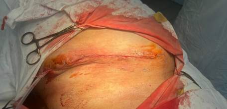 Огромную грыжу размером с голову младенца удалили жителю Грязинского района.