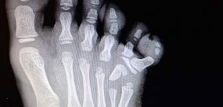 Елецкие врачи провели сложнейшую операцию малышке с аномалией развития стопы. У девочки с рождения был шестой пальчик на ножке!