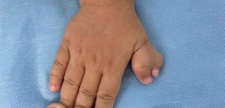 Травматологи из Ельца успешно удалили шестой пальчик на ручке у двухлетней девочки