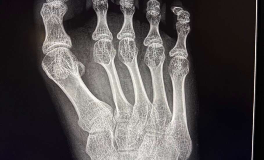 В Елецкой детской больнице проведена сложная операция 17-летней пациентке с детским церебральным параличом