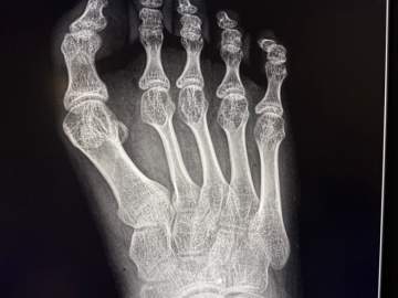 В Елецкой детской больнице проведена сложная операция 17-летней пациентке с детским церебральным параличом