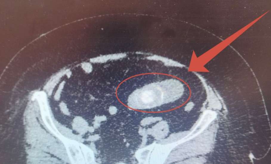 Врачи областной клинической больницы удалили огромный камень в кишечнике женщины