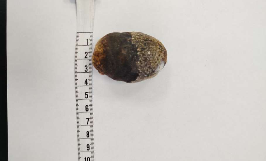 Врачи областной клинической больницы удалили огромный камень в кишечнике женщины