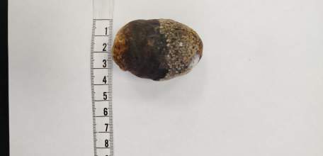 Врачи областной клинической больницы удалили огромный камень в кишечнике женщины