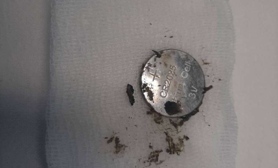 Эндоскописты областной детской больницы извлекли батарейку из пищевода двухлетней девочки