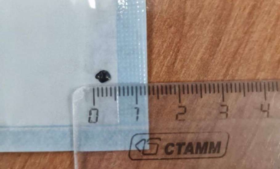 В Липецкий областной клинический центр поступил 45-летний пациент с тяжелейшей травмой.