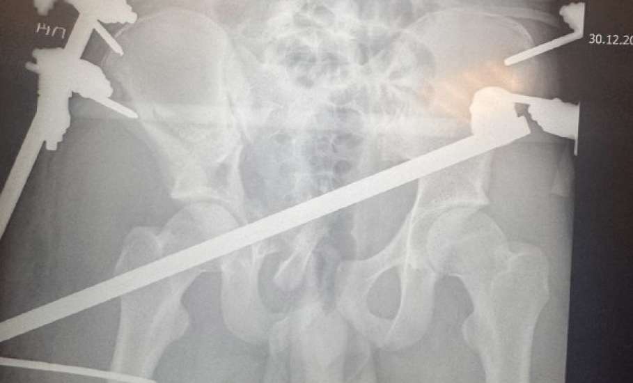 Медики областной детской больницы спасли жизнь подростка, пострадавшего в смертельном ДТП на трассе Липецк-Хлевное