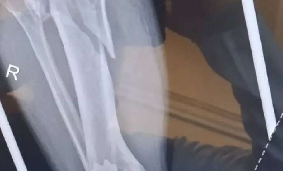 Травматологи горбольницы &laquo;Липецк -  Мед&raquo; почти три часа буквально по кусочкам собирали голени пациента после аварии!