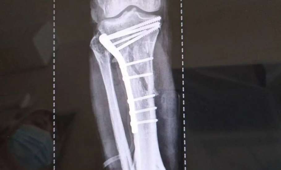 Травматологи горбольницы &laquo;Липецк -  Мед&raquo; почти три часа буквально по кусочкам собирали голени пациента после аварии!