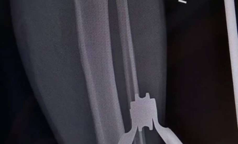 Травматологи горбольницы &laquo;Липецк -  Мед&raquo; почти три часа буквально по кусочкам собирали голени пациента после аварии!