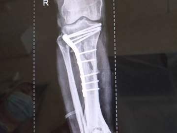 Травматологи горбольницы &laquo;Липецк -  Мед&raquo; почти три часа буквально по кусочкам собирали голени пациента после аварии!