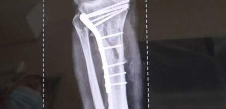 Травматологи горбольницы &laquo;Липецк -  Мед&raquo; почти три часа буквально по кусочкам собирали голени пациента после аварии!