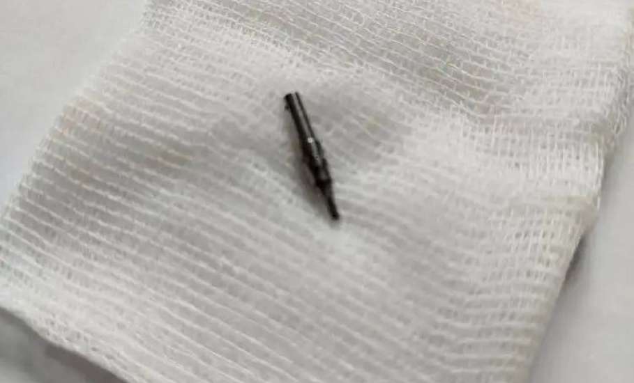 Хирурги Ельца провели сложную операцию: извлекли острый инородный предмет из устья аппендикса мужчины