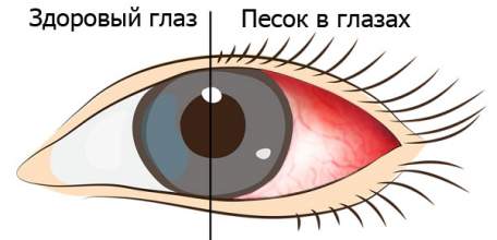 Что делать когда в глазах как будто песок