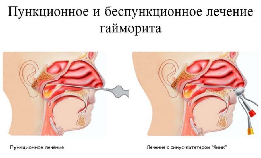 Лечение гайморита без прокола с помощью синус-катетера Ямик
