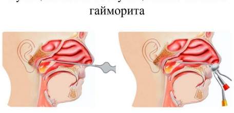 Лечение гайморита без прокола с помощью синус-катетера Ямик