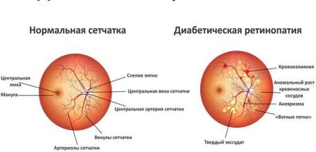 Диабетическая ретинопатия: симптомы и лечение