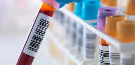 В Клинике доктора Шаталова можно сдать анализ на холестерин