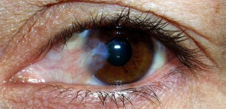 Лечение птеригиума в Клинике Доктора Шаталова