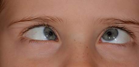 Лечение косоглазия в Клинике Доктора Шаталова